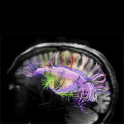 Stunning diffusion spectrum imaging to infer the position of nerve fibers in the living human brain.